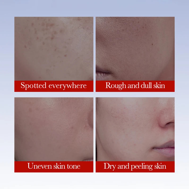 SADOER Anti-Sommersprossen-Creme, aufhellende Gesichtscreme, Anti-Aging-Feuchtigkeitspflege zur Entfernung von Pigmentflecken und Sommersprossen, Gesichtspflege